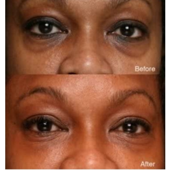 🆕Under Eye dark circles & Puffiness treatment - Picture 7 of 12